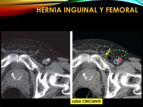 hernia inguinal bilateral de contenido graso
